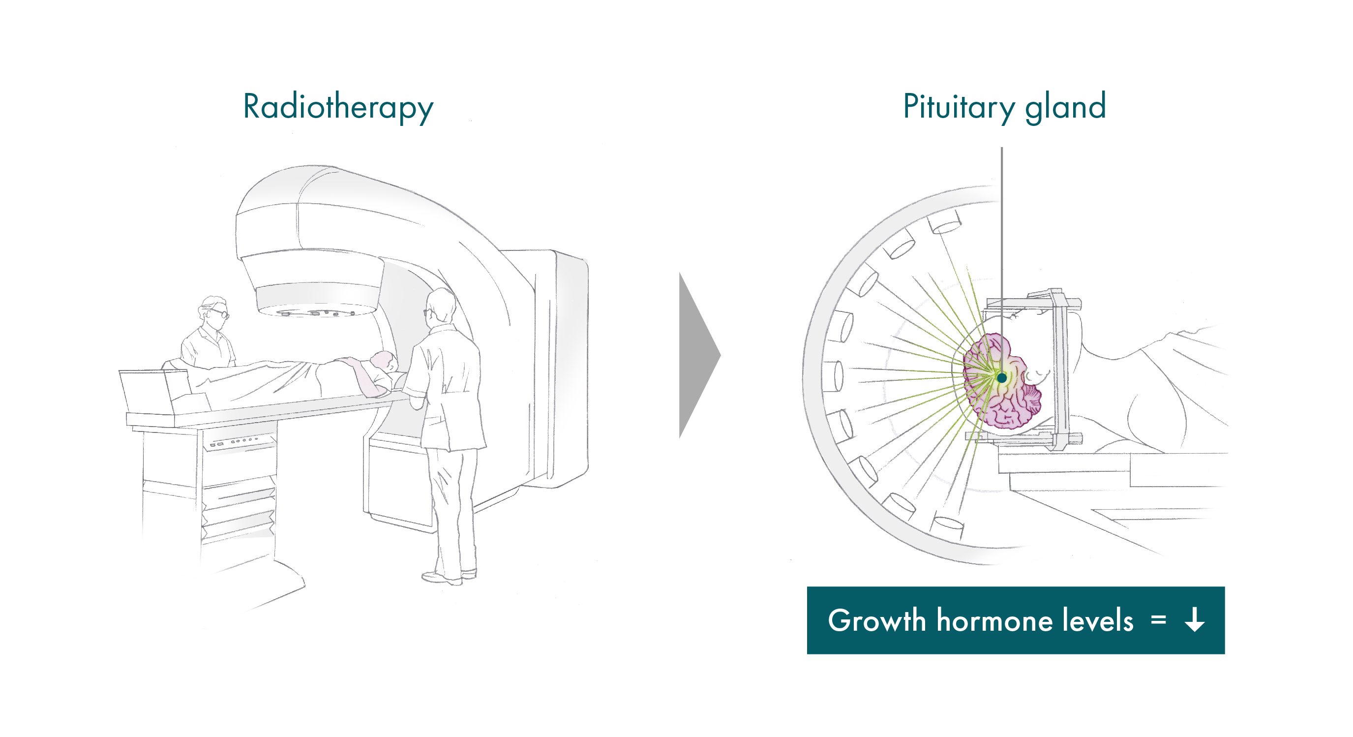 ADVZ body radiotherapy for acromegaly